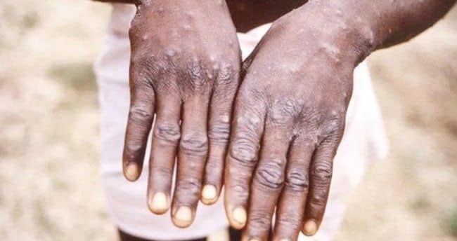 Böyük Britaniyada meymun çiçəyinə yoluxanların sayı 56-ya çatıb