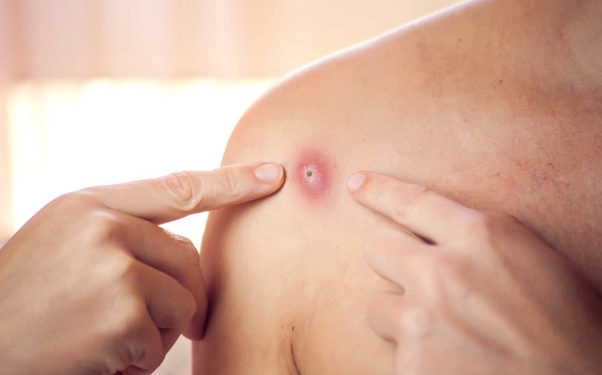 Число случаев заражения оспой обезьян в Британии достигло 106