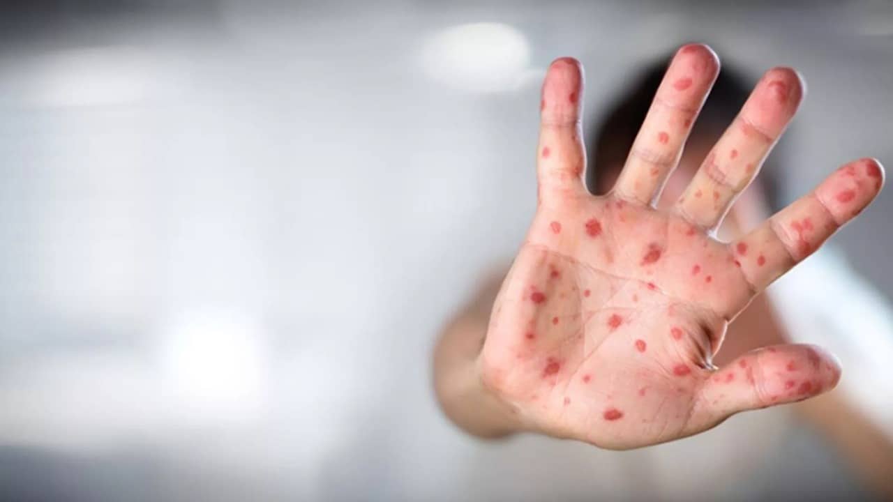 İngiltərədə meymunçiçəyi yoluxmasının sayı 179-a yüksəlib