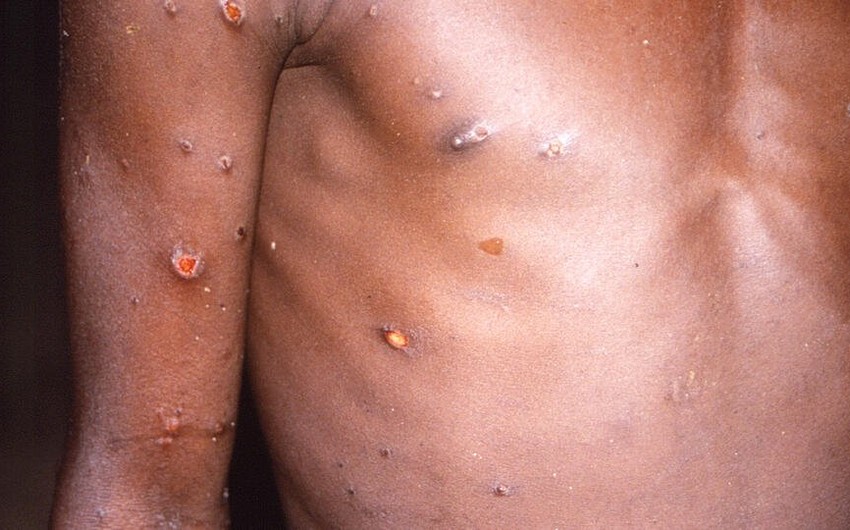 ÜST: Meymunçiçəyinə 30 ölkədə 550-dən çox yoluxma qeydə alınıb