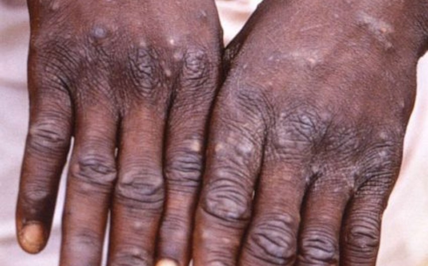 Bir həftə ərzində qeyri-endemik ölkələrdə meymunçiçəyinə 505 yoluxma halı qeydə alınıb