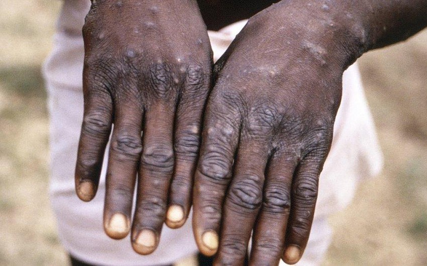 В Канаде число случаев заражения людей оспой обезьян возросло до 112