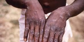 Yaşı 40-dan yuxarı olan şəxslər üçün meymunçiçəyinin qorxusu yoxdur - RƏSMİ