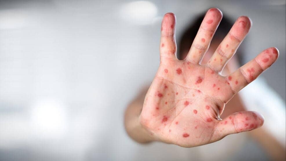 Livanda meymunçiçəyinə ilk yoluxma halı aşkarlanıb