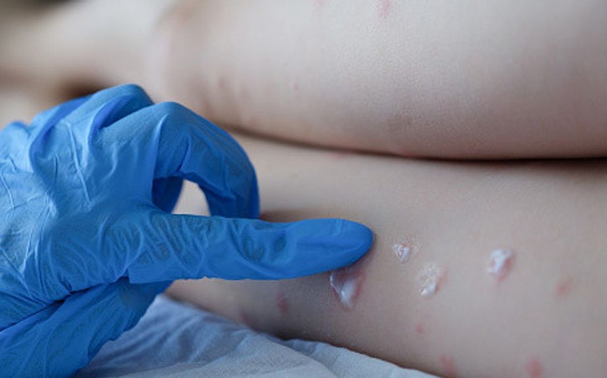 Meymunçiçəyinin sağalma müddəti və müalicədə istifadə olunan dərmanlar açıqlanıb