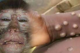 Niderlandda ilk dəfə uşaqda meymunçiçəyi aşkarlanıb