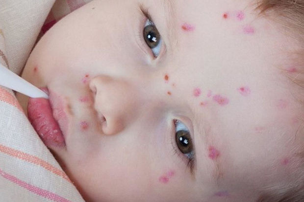 TƏBİB-dən suçiçəyi ilə bağlı ÜST-ə MÜRACİƏT