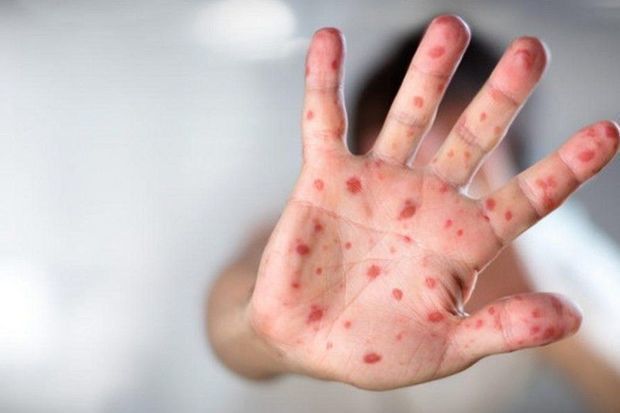 Meymunçiçəyinin yeni simptomu AÇIQLANDI