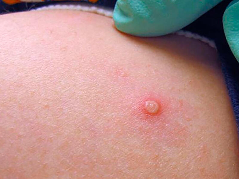 Azərbaycanda meymunçiçəyinə yoluxma qeydə alınmayıb - RƏSMİ