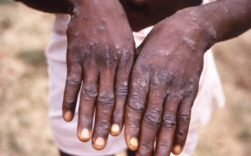 İspaniyada meymunçiçəyindən ilk ölüm qeydə alınıb