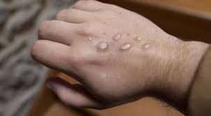 В Германии оспой обезьян впервые заразились подростки