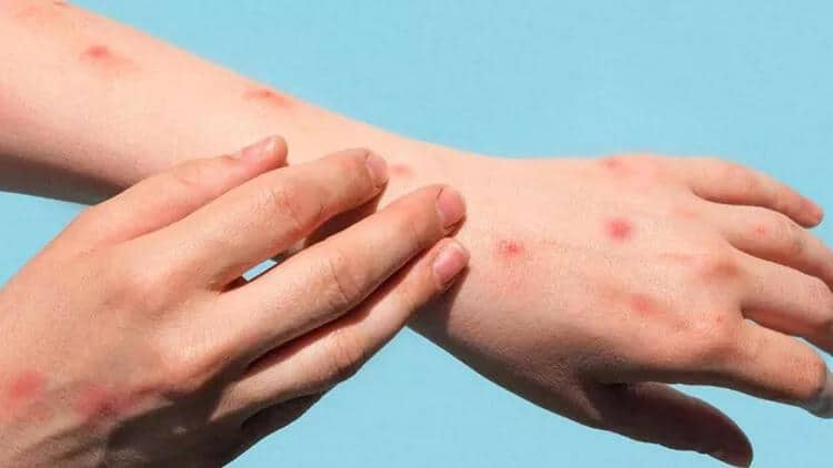 Almaniyada 4 yaşında uşaqda meymunçiçəyi aşkarlandı