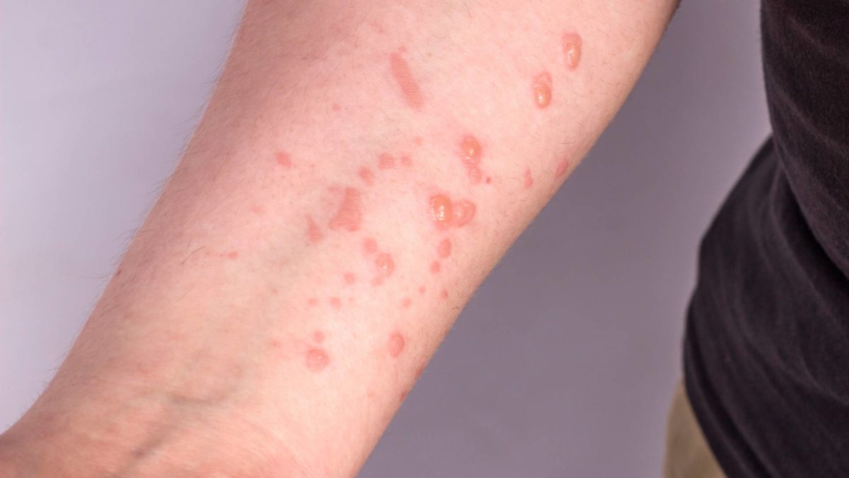 Daha bir ölkədə meymunçiçəyinə ilk yoluxma qeydə alınıb