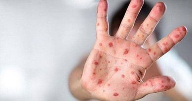 ABŞ-da meymunçiçəyindən ilk ölüm qeydə alınıb