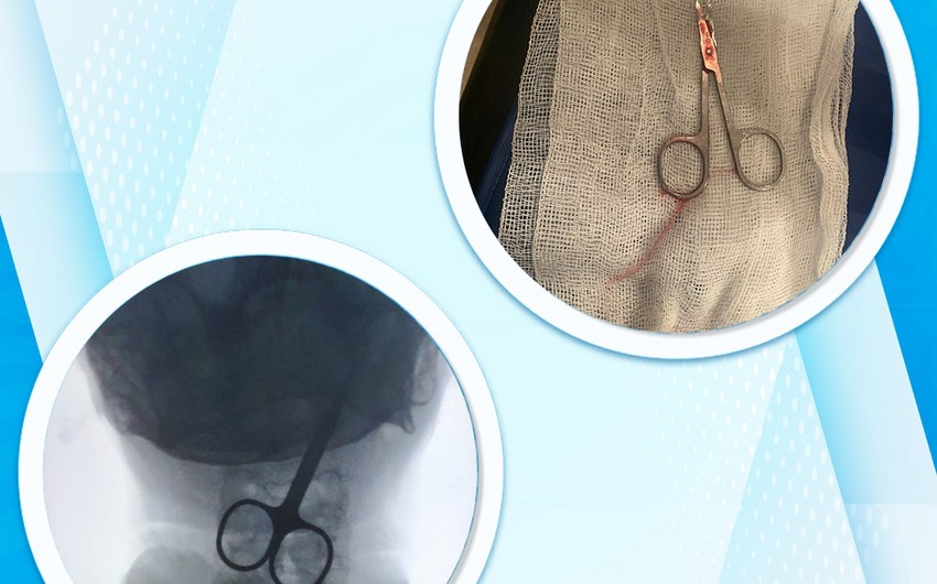 Bakı sakini qayçı udub - FOTO