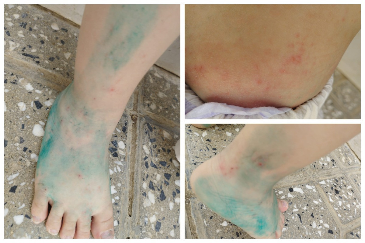 TƏBİB: Sığınacaq mərkəzində uşaqlar arasında yayılan dəri xəstəliyi qotur deyil