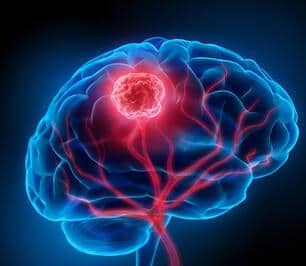 Beyin xərçənginə qarşı yeni implant: Hər il 200.000 ölümün qarşısı alına bilər