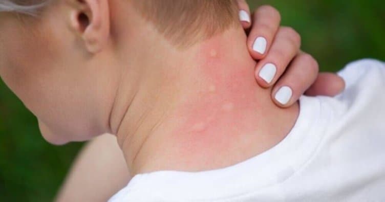 Ağcaqanadlar vasitəsilə yayılan yeni virus - Bu ölkə üçün xəbərdarlıq edildi