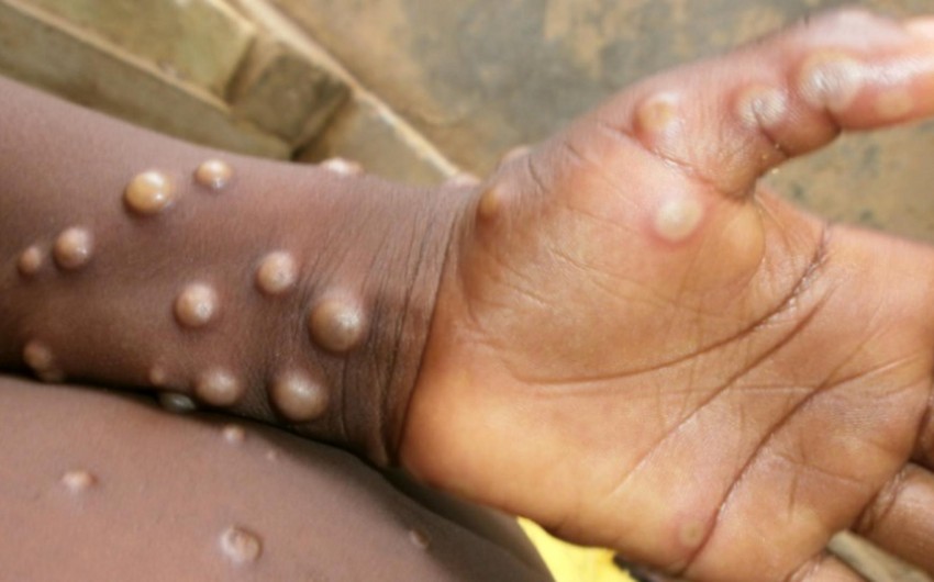 Çilidə meymunçiçəyindən ilk ölüm qeydə alınıb