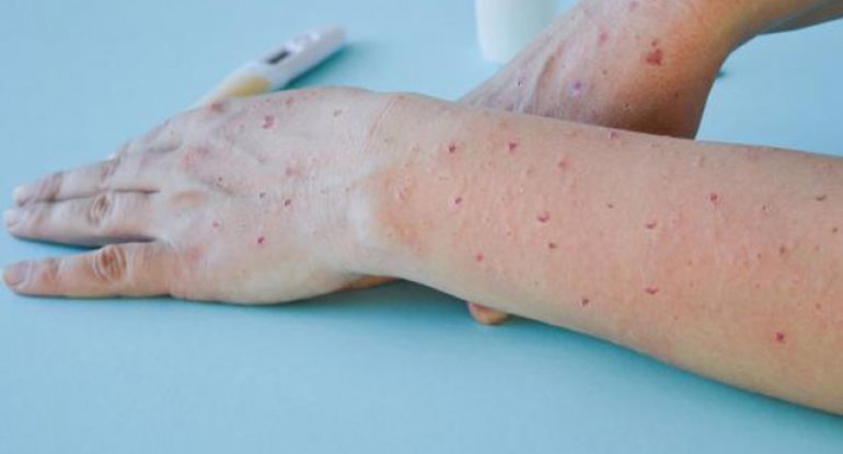 Meymunçiçəyi bundan sonra belə adlanacaq