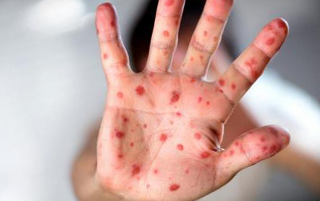 14 yaşlı yeniyetmə qızılcadan ölübmüş