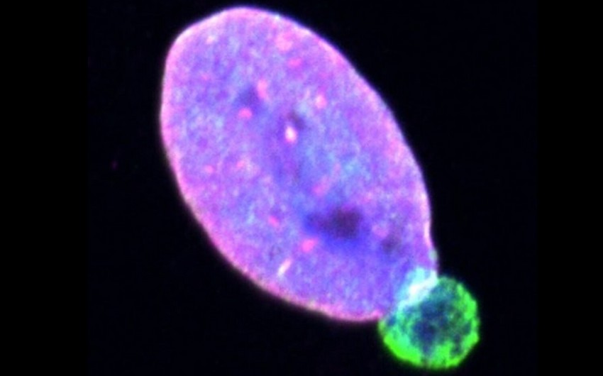 Həkimlər dəri xərçənginin bütün bədənə yayılmasına kömək edən zülal aşkar ediblər