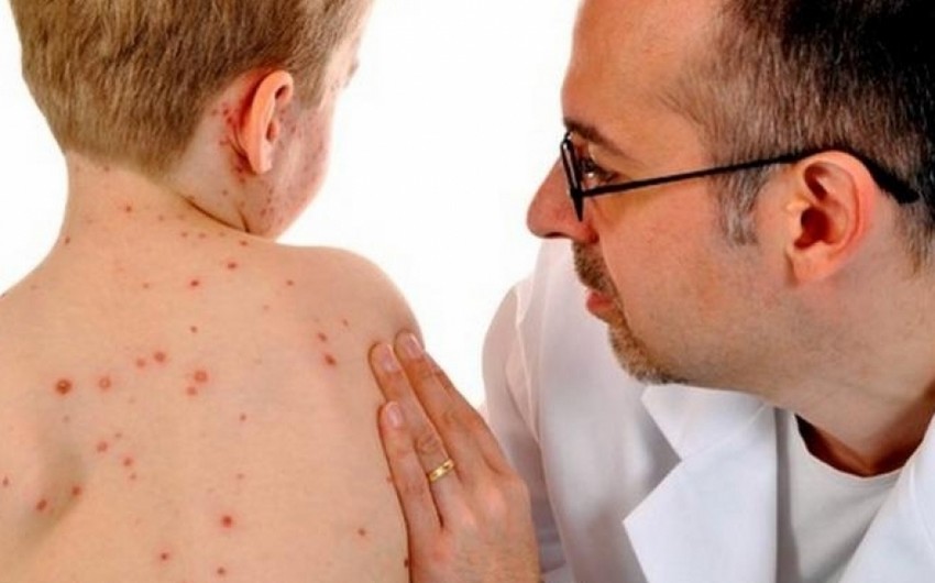 Число зараженных корью в Армении увеличилось до 46