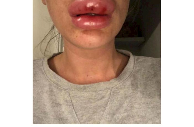 Bakıda dodaq dolğusu etdirən qadının başına iş gəldi