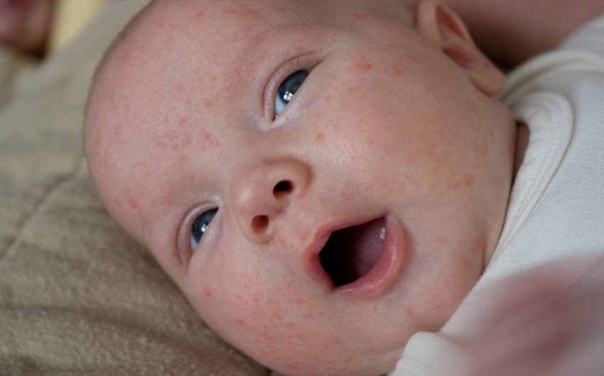 Dağıstanda qızılcaya 200-ə yaxın yoluxma halı müəyyən edilib