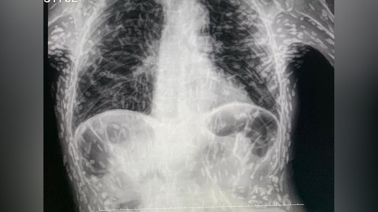 Öskürək tutması ilə xəstəxanaya getdi, mədəsindən yüzlərlə qurd çıxarıldı