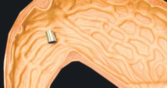 Bədəndə üzə bilən milirobot hazırlanıb