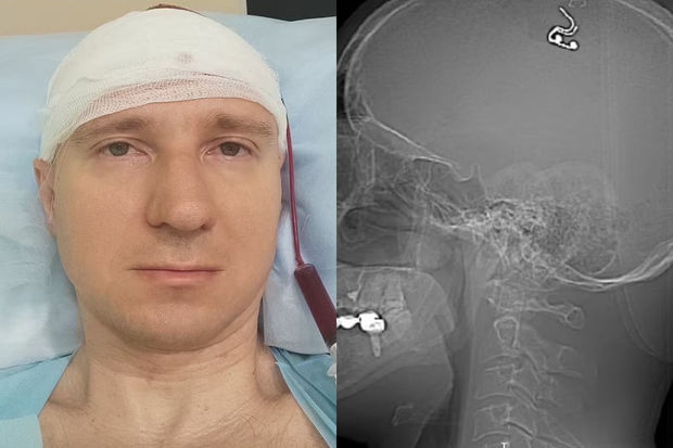 Rusiya sakini yuxularını idarə etmək istədi: Drellə beynini deşərək elektrod yerləşdirdi - FOTO