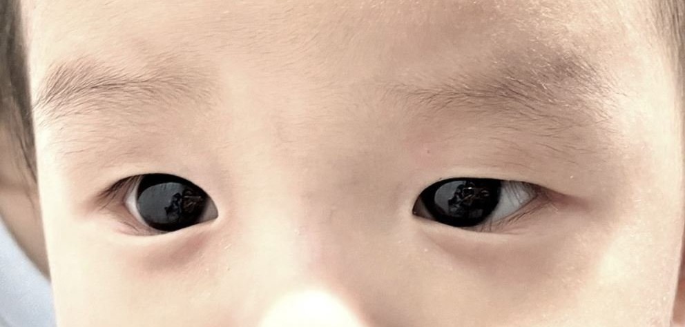 Covid-19 müalicəsi alan körpənin göz rəngi dəyişdi – qəribə hadisə