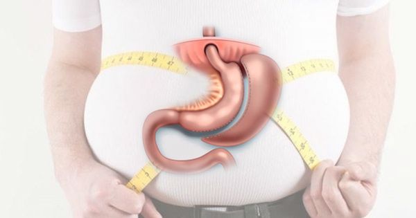 Mədəkiçiltmə əməliyyatları nəticəsində ölüm belə qaçılmaz olur - Həkimdən ÇAĞIRIŞ