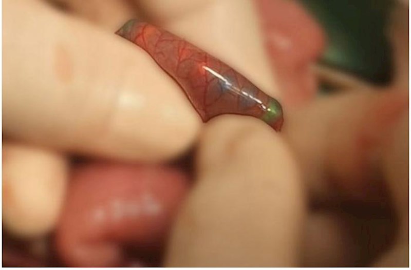 Mingəçevirdə yad cisim udan azyaşlının həyatı xilas olunub — FOTO