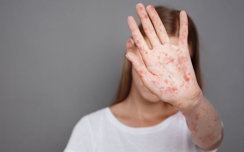 Səhiyyə Nazirliyi qızılca xəstəliyi ilə bağlı vətəndaşlara müraciət edib