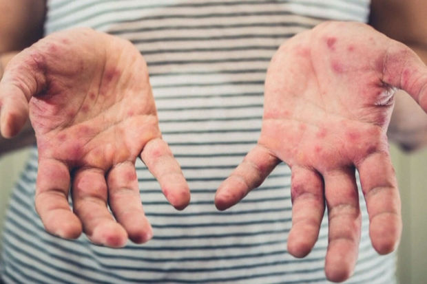 Cəlilabadda 10 tələbə qızılcaya yoluxdu