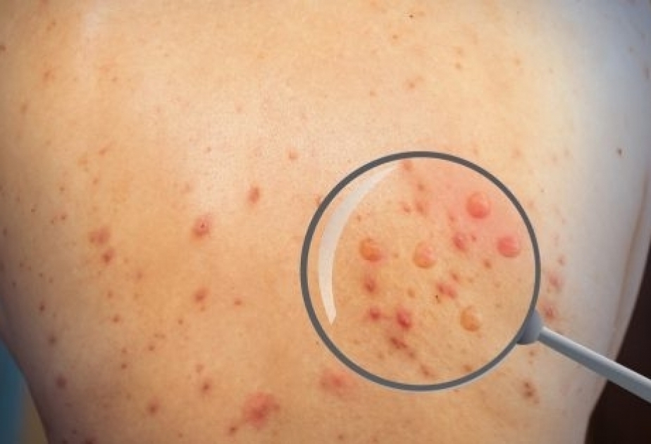 ÜST: 2022-ci ilin əvvəlindən dünyada meymunçiçəyinə 92 min yoluxma aşkarlanıb