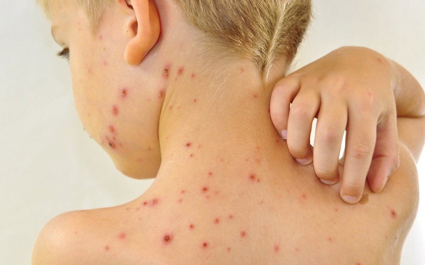 Bu il Azərbaycanda 284 nəfər qızılcaya yoluxub