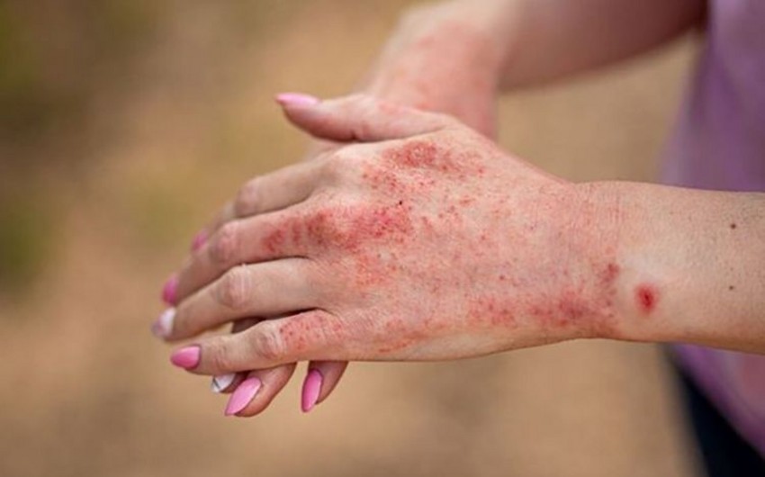 Qızılcaya yoluxanlara antibiotik vurmaq olmaz - RƏSMİ