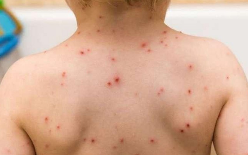 Qızılcanın insanlar üçün yaratdığı təhlükə açıqlanıb