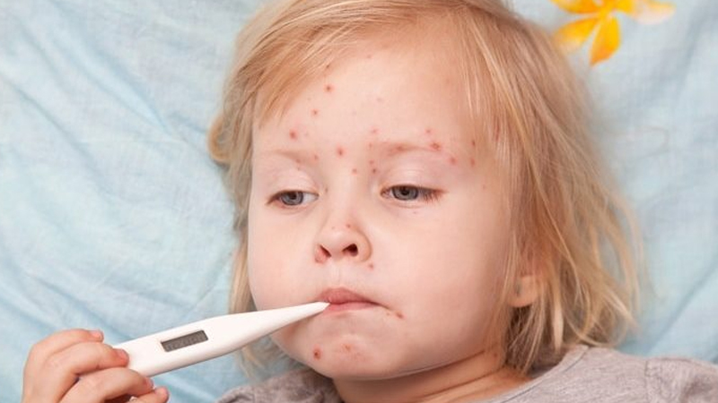 Əvvəllər qızılca keçirənlər ikinci dəfə yoluxa bilərlər?