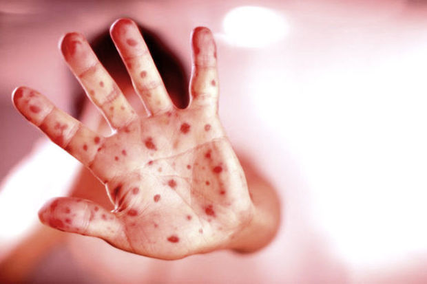 Rumıniyada qızılca epidemiyası elan edilib