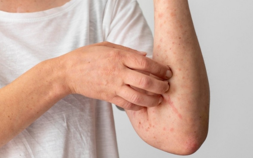 В Румынии объявили эпидемию кори