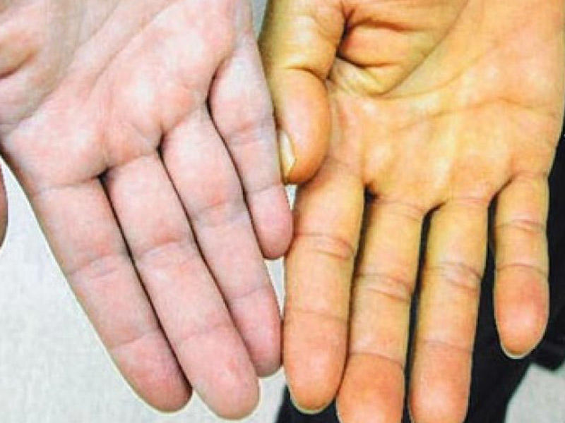 ÜST-dən sarılıq xəbərdarlığı: Minlərlə insan risk altındadır