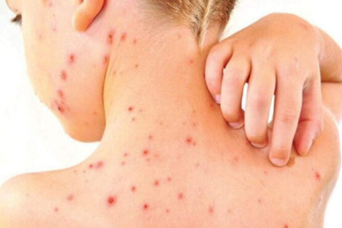 Azərbaycanda qızılcaya yoluxma halları azalır