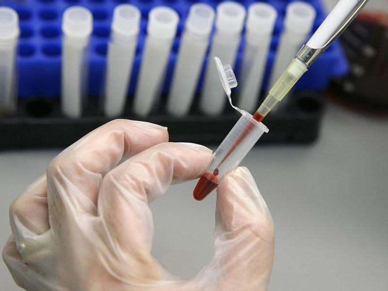 SN: Bu şəxslər Hepatit A virusuna daha çox yoluxur