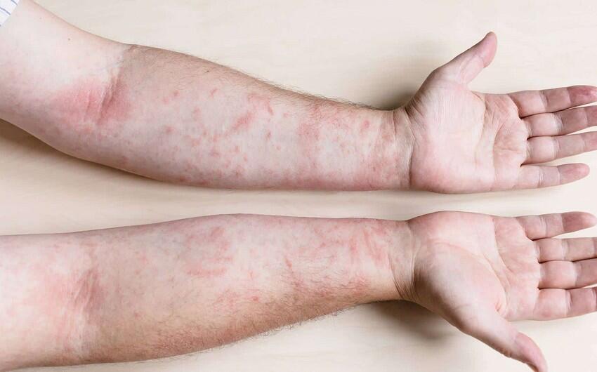 Bu bölgəmizdə qızılcaya yoluxma sayında yenidən artdı