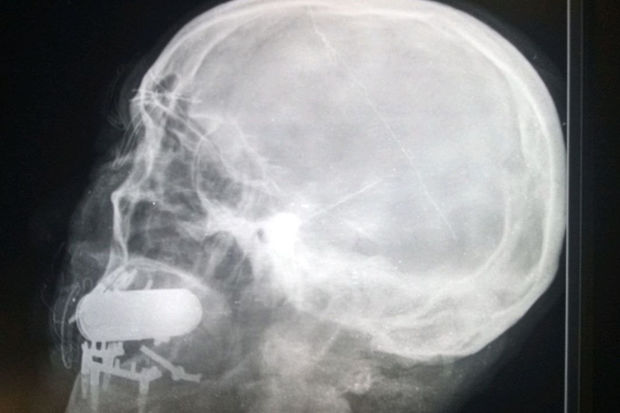 Rusiyada hərbçinin yanağından çıxan əşya hər kəsi heyrətləndirdi - FOTO/VİDEO