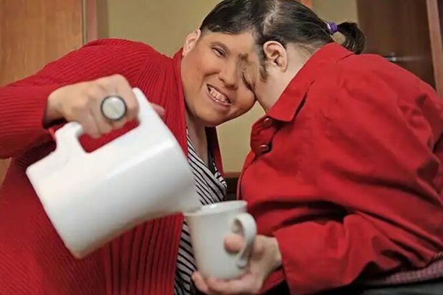 Dünyanın ən yaşlı siam əkizləri vəfat ediblər